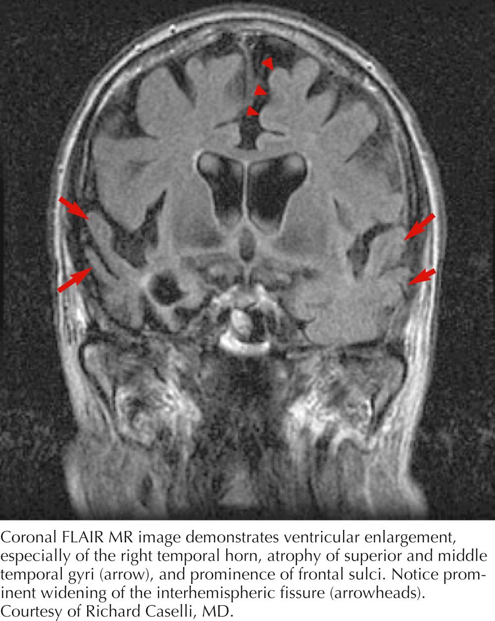 Fig. 62.6, Frontotemporal Atrophy.