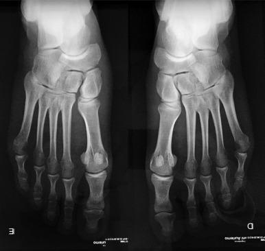 Fig. 25.1, Subsequent weight-bearing x-ray after 1 week of rest demonstrates widening at Lisfranc joint.