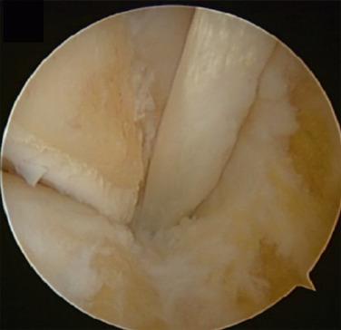 Fig. 25.11, After removal of the Os Trigonum and soft tissues, subtalar surface and flexor halluces longus tunnel are well delineated. Care must be taken not to over-resect bone tissue and damage healthy cartilage.