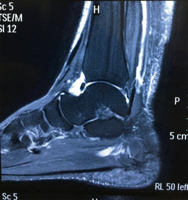 Fig. 25.12, Loose body in the anterior compartment of the ankle.