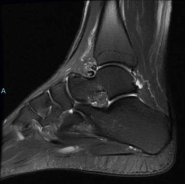 Fig. 25.13, Professional volleyball player with loose fragments of kissing osteophytes.