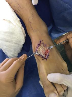 Fig. 25.2, A professional goalkeeper (same as Fig. 25.1 ). Dorsal approach for subtle Lisfranc injury.