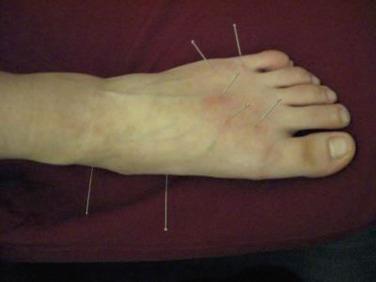 Fig. 25.26, Acupuncture treatment at the foot.