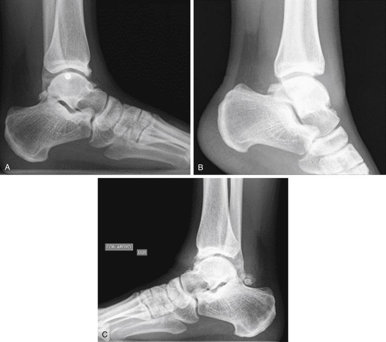 Fig. 25.29, A, Preop x-rays. B, 7 months postop. C , 2 years postop.