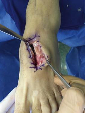 Fig. 25.3, A proximal intercuneiform lesion is appreciated with manual stress.