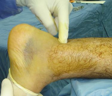 Fig. 25.31, Rupture gap in Achilles tendon.