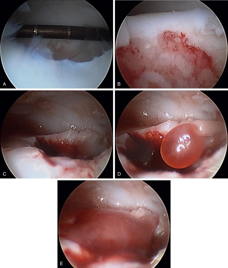 Fig. 25.34, Talar osteochondral defect (OCD) treated with mesenchymal stem cells (MSCs)/platelet-rich fibrin glue (PR-FG) mixture. A , Medial talar dome OCD measuring 7 mm x 8 mm. B , OCD after debridement to a stable rim and healthy bleeding subchondral bone. C , Establishing dry arthroscopy before implantation of the MSC/Fibrin glue mixture. D , Injection of the MSCs/PR-FG from the dual barrel syringe arthroscopically into the base of the defect. E , The mixture is set level with the surrounding cartilage and left to dry for 7 minutes after which the construct’s stability is verified by ranging the ankle under arthroscopic visualization.