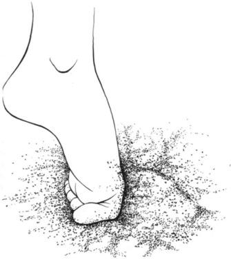 Fig. 25.5, Mechanism of the sand toe injury‒hallux in hyperflexed into the sand.