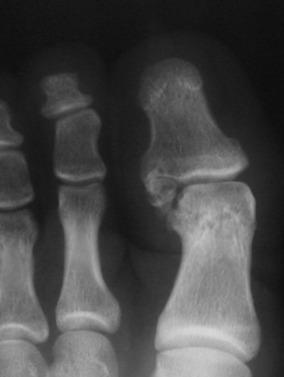 Fig. 25.6, Osteochondral injury of the hallux in beach soccer.