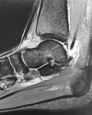 Fig. 25.7, Flexor halluces longus tendinitis caused by impinging effect from Os Trigonum Syndrome.