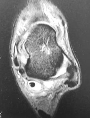 Fig. 25.8, Flexor halluces longus is involved with extensive tenosynovitis, proximal to its tunnel.