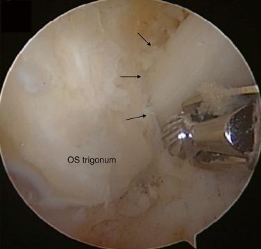 Fig. 25.9, Os Trigonum impinging against posterior subtalar and ankle joints. Note the narrowing of the flexor halluces longus tunnel.