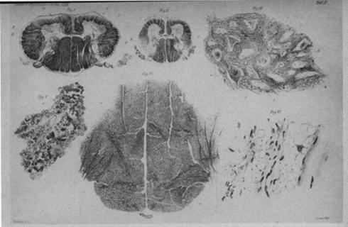Figure 5.1, Histological analysis of Werdnig’s first case study. Cross section of seventh cervical level showing honeycombed anterior horn (I); cross section of second lumbar level (II); anterior horn at L2–3 level, demonstrating empty cell beds (b, c) and some shriveled ganglion cells (III); posterior columns at sixth cervical nerve level (IV); posterior columns at sixth cervical level, higher magnification (V); longitudinal section of gastrocnemius muscle displaying fiber atrophy (VI). 12
