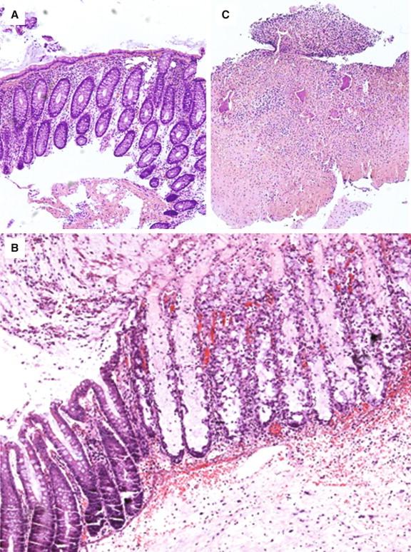 Figure 17-1, H&E stains of patients with Clostridium difficile having stool EIA and PCR positivity. Apparent is a spectrum of disease from minimal changes in the colon (A) , to pseudomembranous colitis (B) , to complete necrosis of the colonic wall (C) .