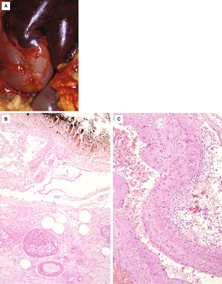 Figure 17-2, Patients with Clostridium perfringens necrotizing enterocolitis (also known as pigbel, Darmbrand, or fire belly). A, Gross photograph shows the necrotic portions of the bowel to the side of viable intestinal loops. B, Microscopic photograph shows necrosis of the different intestinal layers. C, Close-up shows mild inflammatory infiltrate for the amount of necrosis.