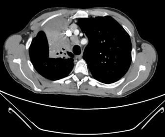 Fig. 41.3, Computed tomographic scan showing mediastinal lymphadenopathy in the pretracheal area and obstruction of the right upper lobe bronchus.