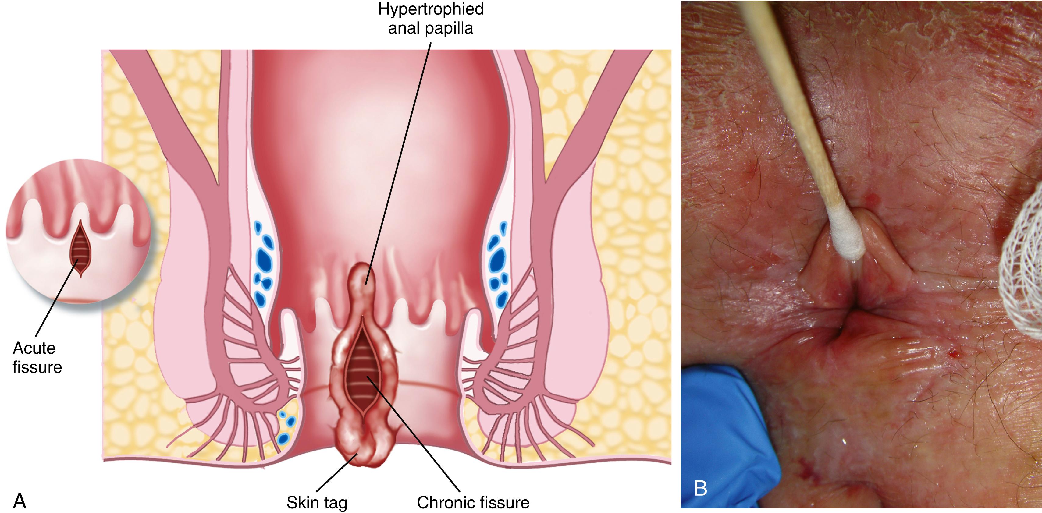 Fig. 129.2, A, Schematic depiction of acute and chronic anal fissures. An acute fissure is depicted in the inset on the left as simply a split in the anoderm. A chronic fissure usually shows signs of chronicity with rolled edges, fibrosis, a hypertrophied anal papilla proximally, a tender distal skin tag, and exposed internal anal musculature. B, Inspection of an acute anal fissure with a cotton-tip swab. Once an acute fissure is identified, no internal examination is needed until the fissure is healed.