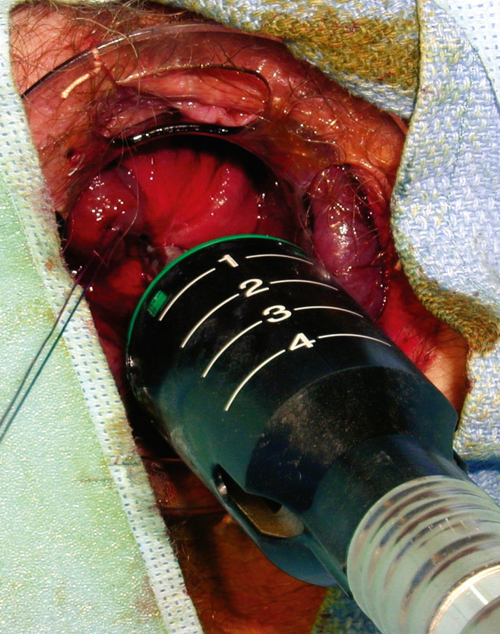 Fig. 129.3, Stapled hemorrhoidopexy procedure. A purse-string suture is placed at the top of the hemorrhoidal column, around which a circular stapler is applied to resect the upper hemorrhoidal tissue, disrupt the hemorrhoidal blood supply and restore the prolapsing distal hemorrhoidal tissue back into the anal canal.