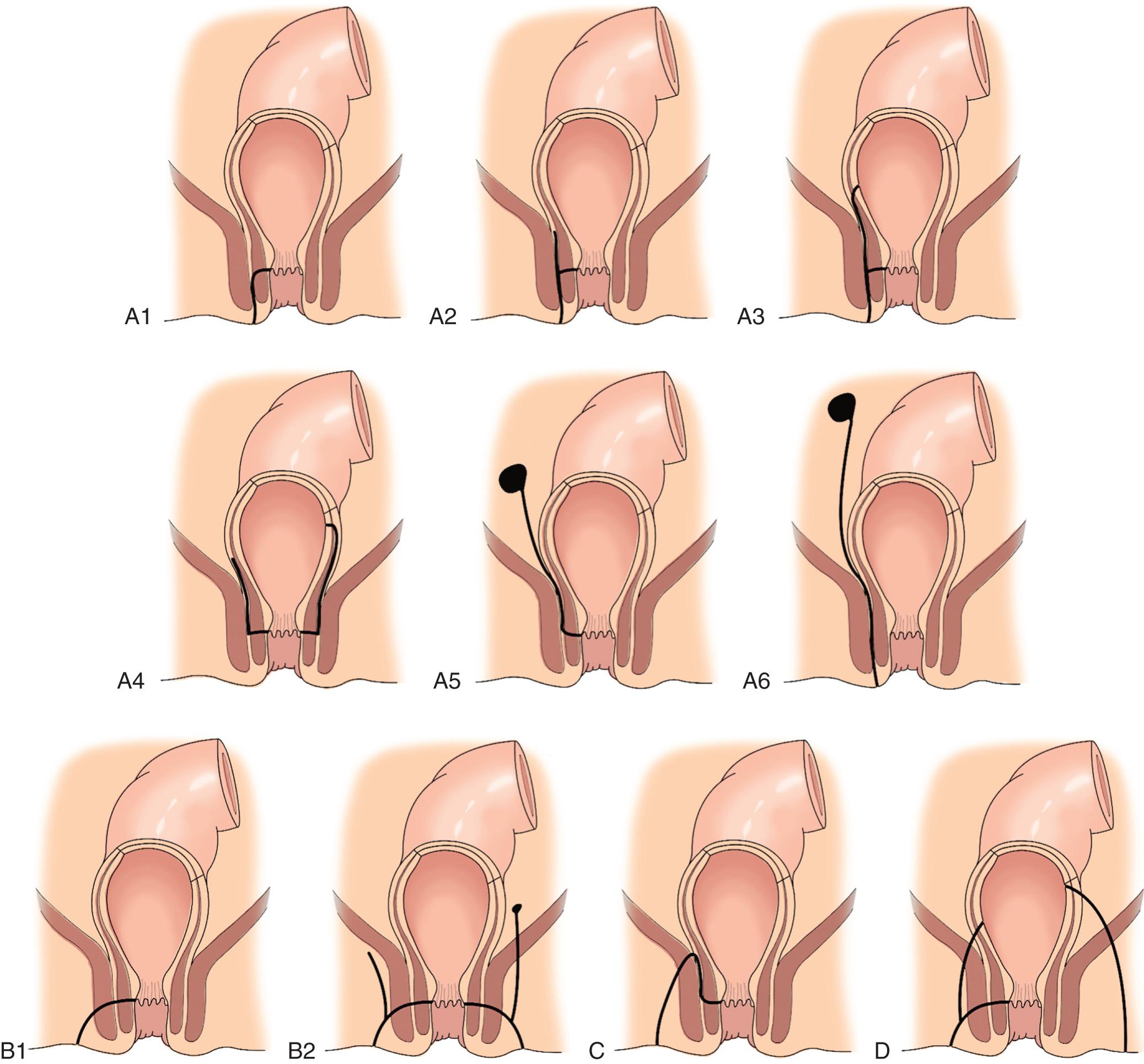 FIGURE 160.2, Classification of anal fistulas. (A) Intersphincteric: the tract remains in the intersphincteric plane. 1, Simple. 2, High blind tract. There is a high extension of the fistula between the internal sphincter and the longitudinal muscle of the upper anal canal. 3, High tract with rectal opening. 4, High intersphincteric fistula without a perineal opening. There may or may not be a rectal opening. 5, High intersphincteric fistula with a pelvic extension. The infection spreads up to reach the true pelvic cavity lying above the levator musculature. 6, Intersphincteric fistula secondary to pelvic disease. This fistula results from the spread of pelvic collections via the intersphincteric plane. This does not represent a true anal fistula because its origin is outside the anal area. There is no opening at the dentate line. (B) Transsphincteric: the fistula tract passes from the intersphincteric plane through the external sphincter muscle. 1, Uncomplicated. 2, High blind tract. The upper tract extension may go to the apex of the ischiorectal fossa or extend higher through the levator musculature into the pelvic cavity. (C) Suprasphincteric: there is an upward extension of the fistula tract in the intersphincteric plane. The tract then passes above the level of the puborectalis muscle and continues downward through the ischiorectal fossa to the perianal area. (D) Extrasphincteric: there is a tract that passes from the skin of the perineum through the ischiorectal fossa and the levator muscles before entering the rectal wall. This fistula may be a consequence of an extension of a transsphincteric fistula or secondary to trauma, anorectal disease, or pelvic inflammation.