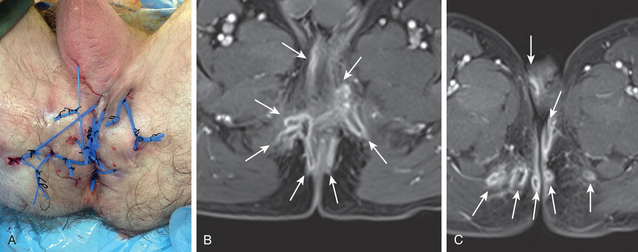 FIGURE 160.3, (A) Watering can perineum with draining setons. (B and C) Fistula tracts shown in axial T1-weighted fat-saturated gadolinium enhanced sequence. Note numerous fistula tracts (arrows) extending anteriorly to scrotum, bilaterally to ischiorectal fossas, and posterior perianal regions.