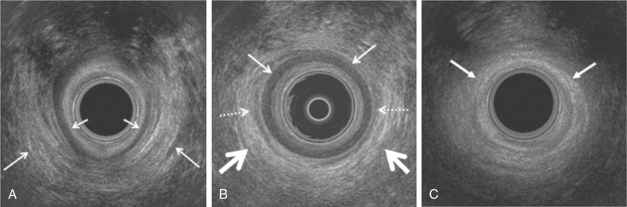 Fig. 22.7, Anal ultrasound. Transverse ultrasound images of the normal anal sphincter. Endoanal ultrasound images at three levels (upper sphincter, midsphincter, and caudal sphincter) at the level of the puborectalis muscle (PRM) shows the internal sphincter, intersphincteric fat, and external sphincter as separate structures. A, Endoanal ultrasound image: transverse image of the cephalad (upper) anal sphincter demonstrating the striated relatively echogenic U -shaped sling of the posterior PRM (long arrows) and the hypoechoic internal anal sphincter (IAS) (short arrows). Note that at this level the external anal sphincter (EAS) is absent. The innermost echogenic ring represents the rectal mucosa and interface with the transducer (central round black structure). B, Normal appearance on endoanal ultrasound of the anal sphincters at the midsphincteric level demonstrating the characteristic target or layered appearance. The inner echogenic ring represents the mucosa and interface with the transducer; the IAS is the subjacent markedly hypoechoic ring (thin arrows), and the outermost ring represents the EAS (thick arrows) and is typically either hyperechoic or of mixed echogenicity. Wispy hypoechoic curvilinear strands with a striated appearance (dotted arrows) between the IAS and EAS represent the longitudinal muscle layer. C, Endoanal ultrasound image: transverse image of the normal caudal or distal anal sphincter image where the echogenic EAS (arrows) extends beyond the IAS, representing the superficial portion of the EAS.