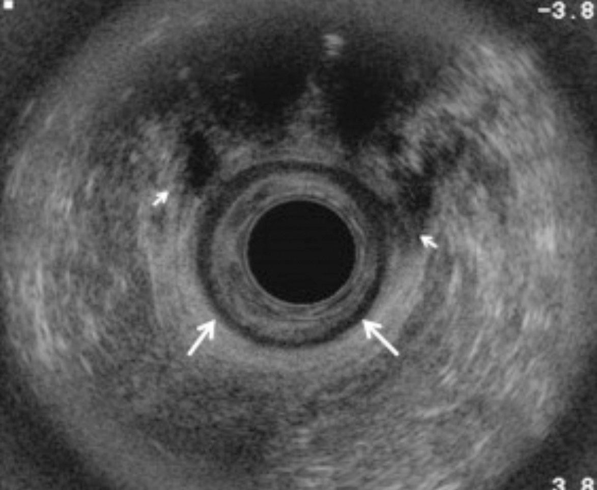 Fig. 22.8, Anal ultrasound: sphincter tear. Endorectal axial ultrasound image demonstrating an intact hypoechoic internal anal sphincter (arrows) but disruption of the anterior aspect of the external anal sphincter (arrowheads) from the 11 o’clock to the 3 o’clock position.