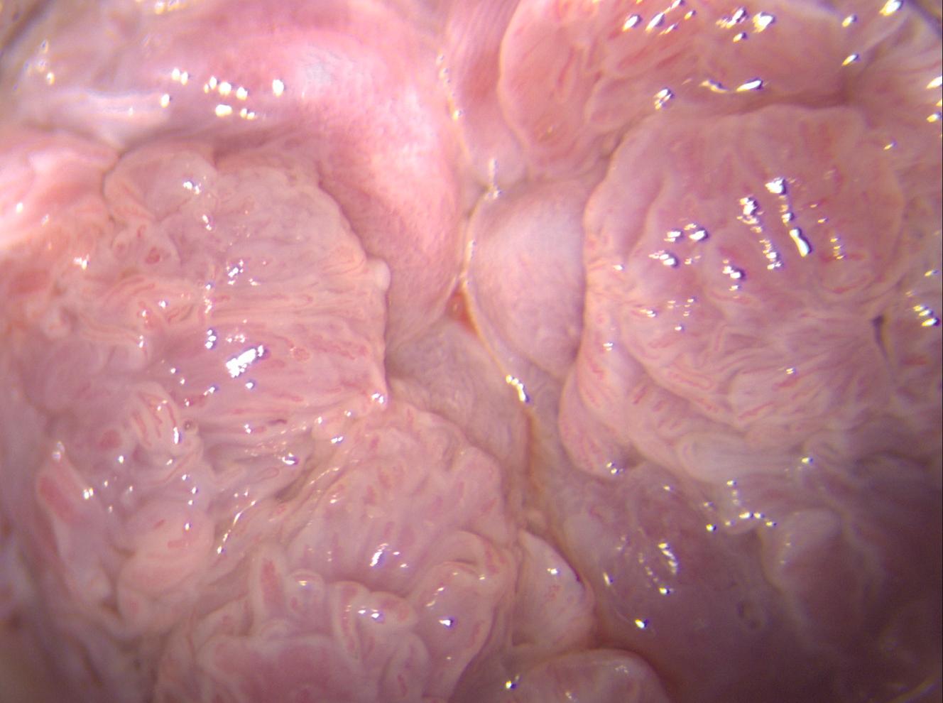 Figure 8.4, Anal canal warts covering squamous epithelium.