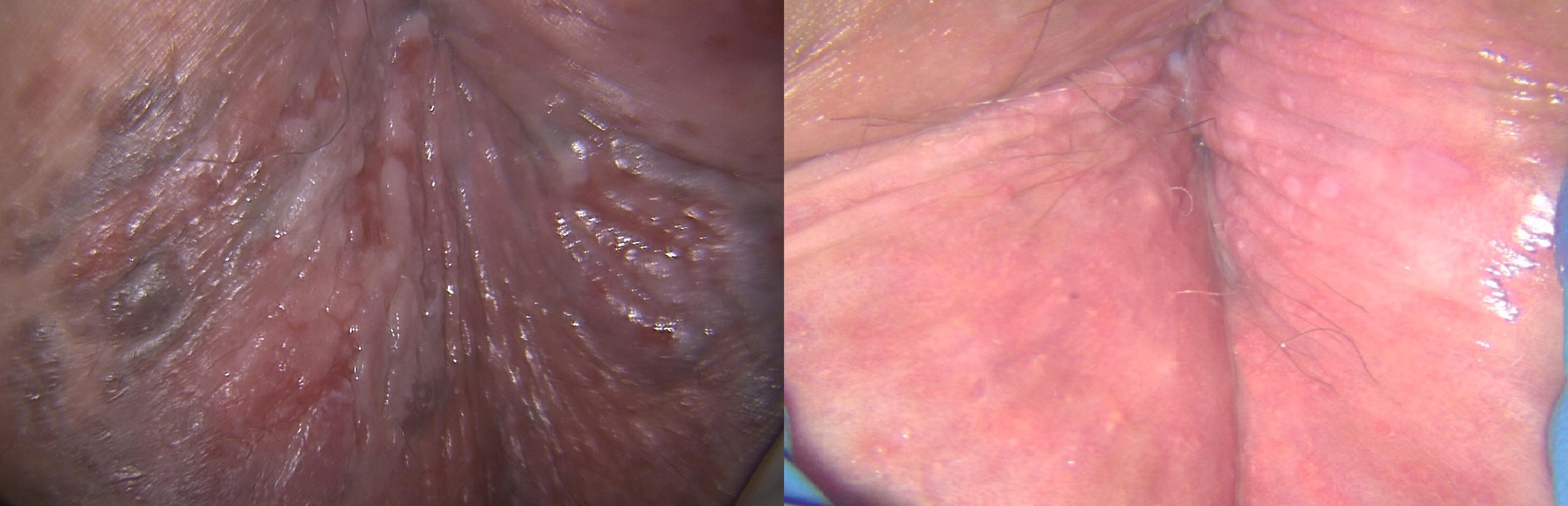 Figure 8.6, Extensive perianal high-grade intra-epithelial lesions (HSIL) field change with focal invasion and appearance after ablation and excision 8 months later.