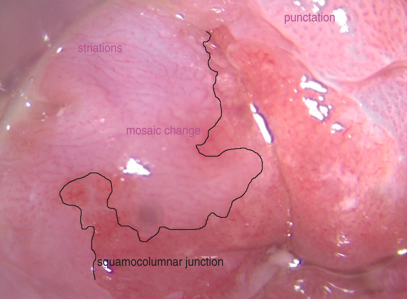 Figure 8.7, High-resolution anoscopy (HRA) image showing high-grade squamous intra-epithelial lesion (HSIL) and squamocolumnar junction (SCJ).