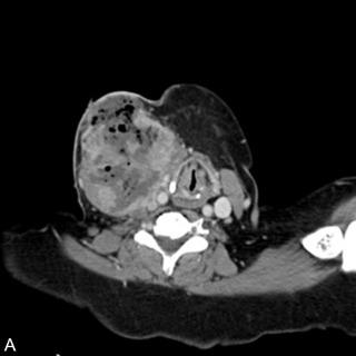 Fig. 28.1, A, Axial view of the computed tomography (CT) scan of the neck, and B, fluorodeoxyglucose-positron emission tomography (FDG-PET) for a patient with anaplastic thyroid cancer depicting large mass, with central necrosis, skin invasion, and tracheal deviation.