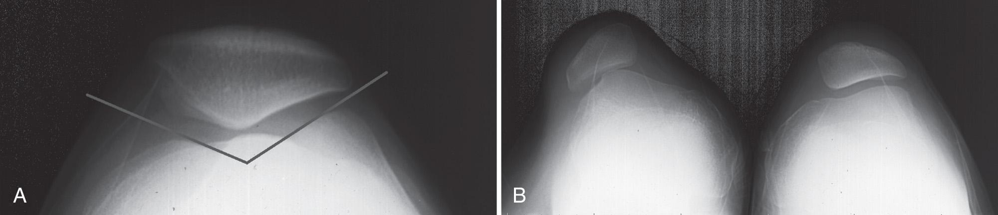 FIG 2.1, Radiographs of the Patellofemoral Joint