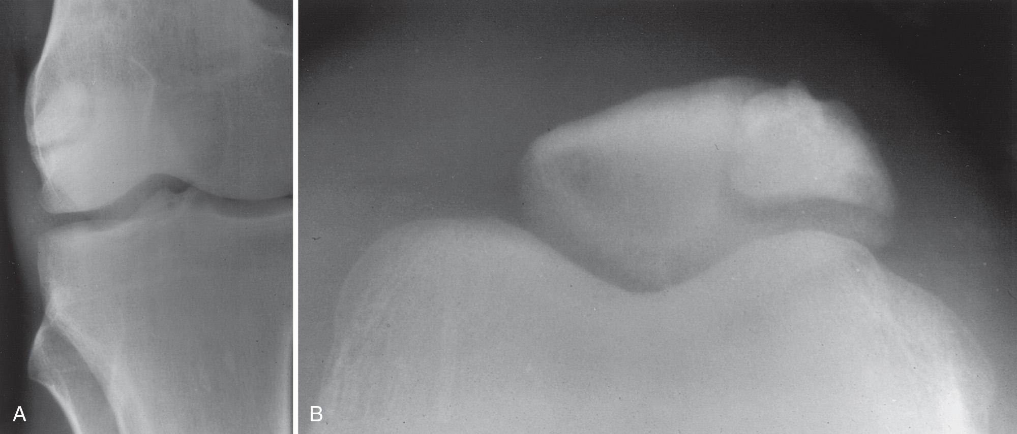 FIG 2.2, Oblique (A) and tangential axial (B) radiographs of a bipartite patella. The margins of the two fragments are relatively smooth and corticated.