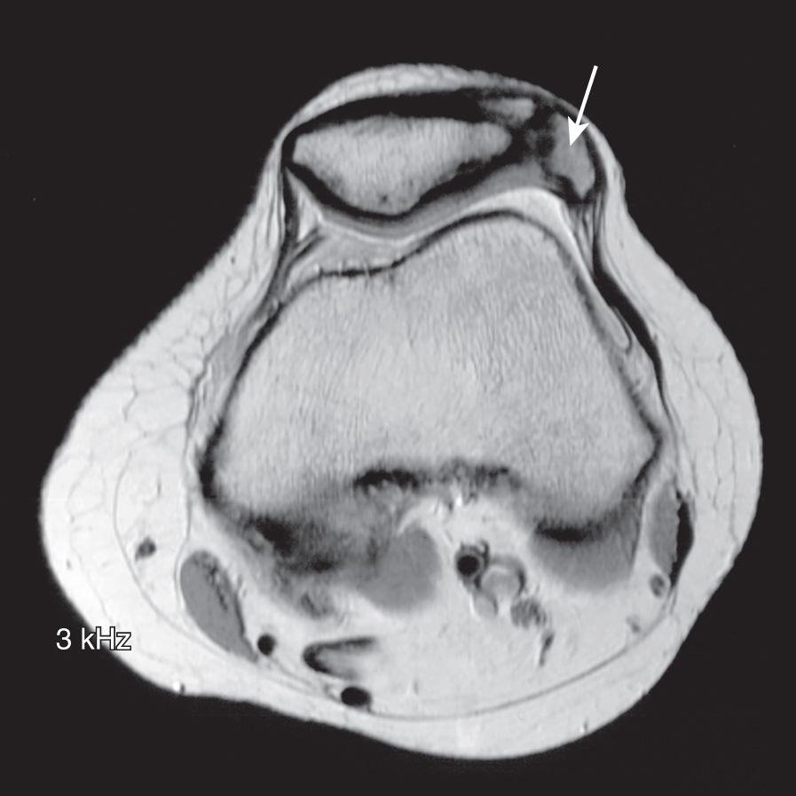 FIG 2.3, Axial magnetic resonance image demonstrating a bipartite patella with a small lateral fragment (arrow) . The lack of surrounding marrow edema and hemorrhage is consistent with a bipartite patella rather than an acute patellar fracture.