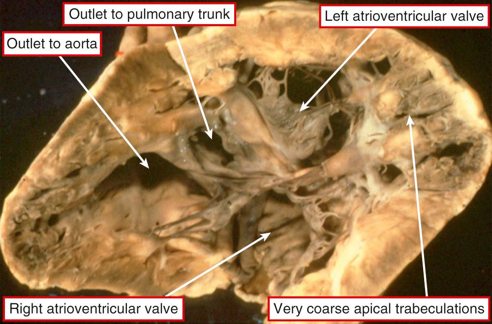 Fig. 69.1, Anatomically solitary ventricle. The heart has been opened in clam-like fashion, showing a double inlet to and a double outlet from a ventricle with exceedingly coarse apical trabeculations. The only septum present is the muscular outlet septum.