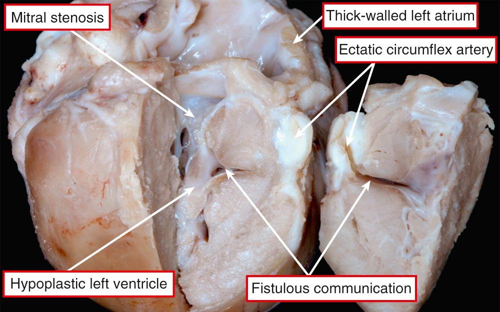 Fig. 69.11, Fistulous communication between the hypoplastic left ventricular cavity and the ectatic circumflex artery in a heart obtained at transplantation from a patient with hypoplastic left heart syndrome with mitral stenosis.