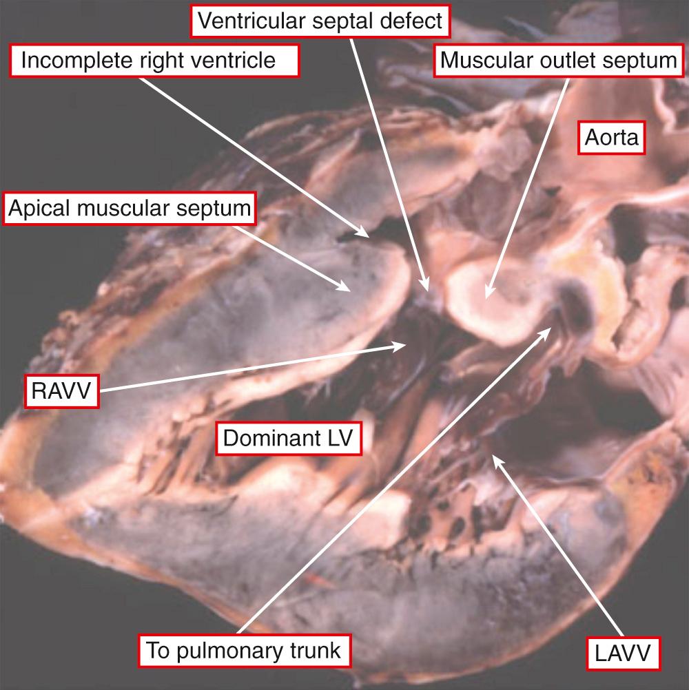 Fig. 69.2, Heart with double-inlet left ventricle (LV) sectioned to replicate the parasternal echocardiographic projection. There is a dominant LV with an incomplete right ventricle positioned anterosuperiorly. The channel between the chambers is a ventricular septal defect, being positioned between the apical and outlet septal components. LAVV and RAVV, Left and right atrioventricular valves.