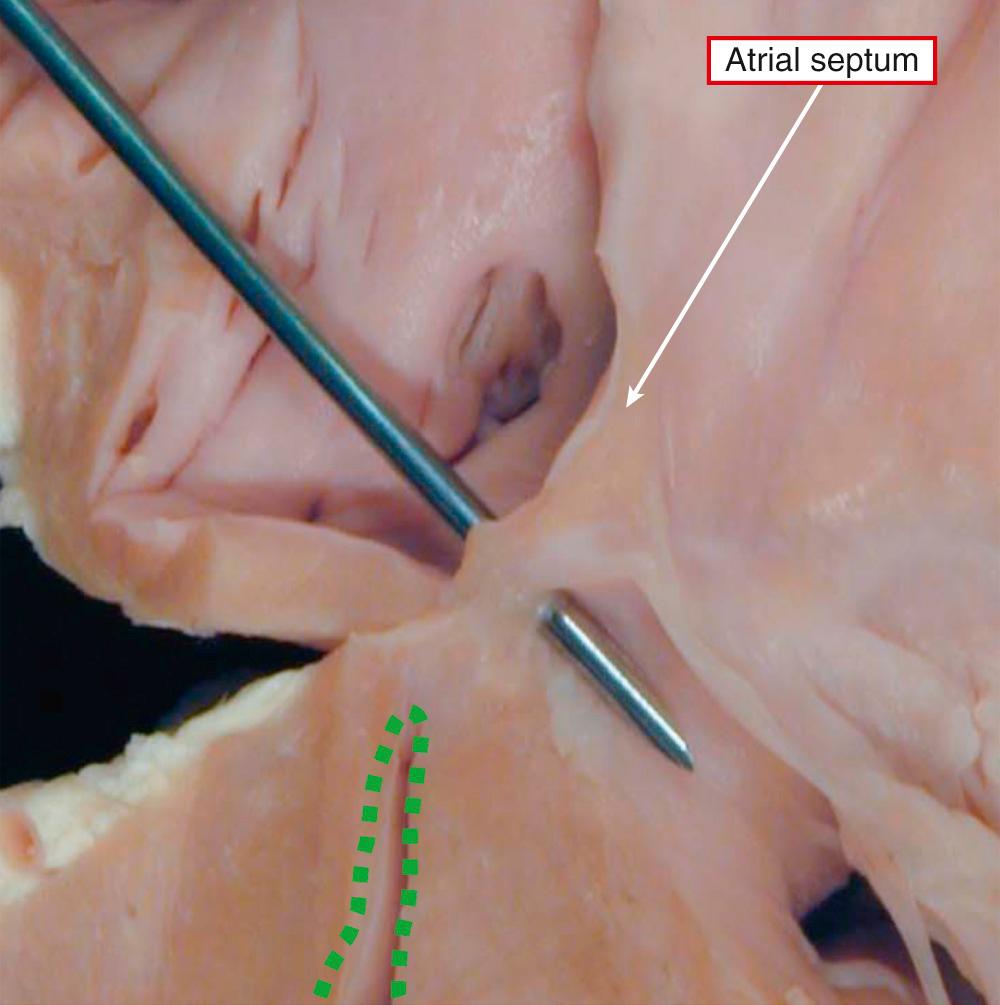 Fig. 69.4, Close-up view of the absent atrioventricular connection that is the essence of tricuspid atresia. The probe has been passed through the “dimple” in the floor of the blind-ending right atrium. It enters the left ventricular outflow tract, since the dimple overlies that atrioventricular component of the membranous septum. The cavity of the right atrium has no connection with the hypoplastic cavity of the incomplete right ventricle (dotted lines) .