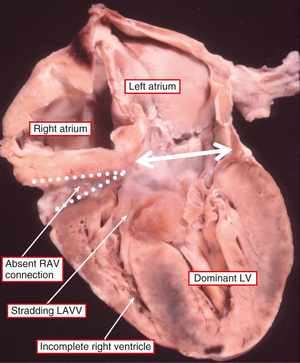 Fig. 69.5, Rare combination of absence of the right atrioventricular (RAV) connection (dotted lines) but with straddling and overriding of the left atrioventricular valve (LAVV). This produces an atrioventricular connection that is uniatrial but biventricular. The left ventricle (LV) is the dominant ventricle, but both ventricles are incomplete.