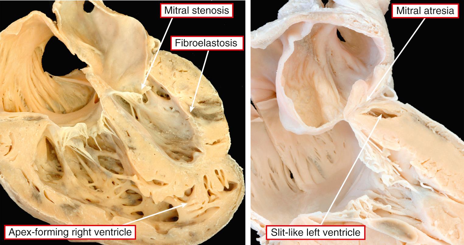 Fig. 69.7, Variations found at the atrioventricular junction in the setting of hypoplastic left heart syndrome. Left, Mitral stenosis. Right, Mitral atresia due to absence of the left atrioventricular connection. Fibroelastosis of the left ventricle is found only in the setting of mitral stenosis.