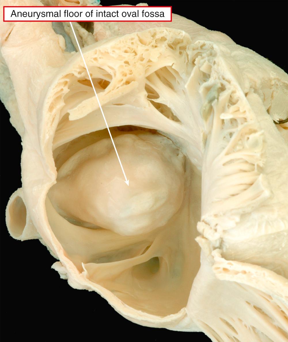 Fig. 69.9, Aneurysmal floor of the intact oval fossa as seen from the right atrial aspect. A four-chamber section of the heart is shown in at right in Fig. 69.7 .