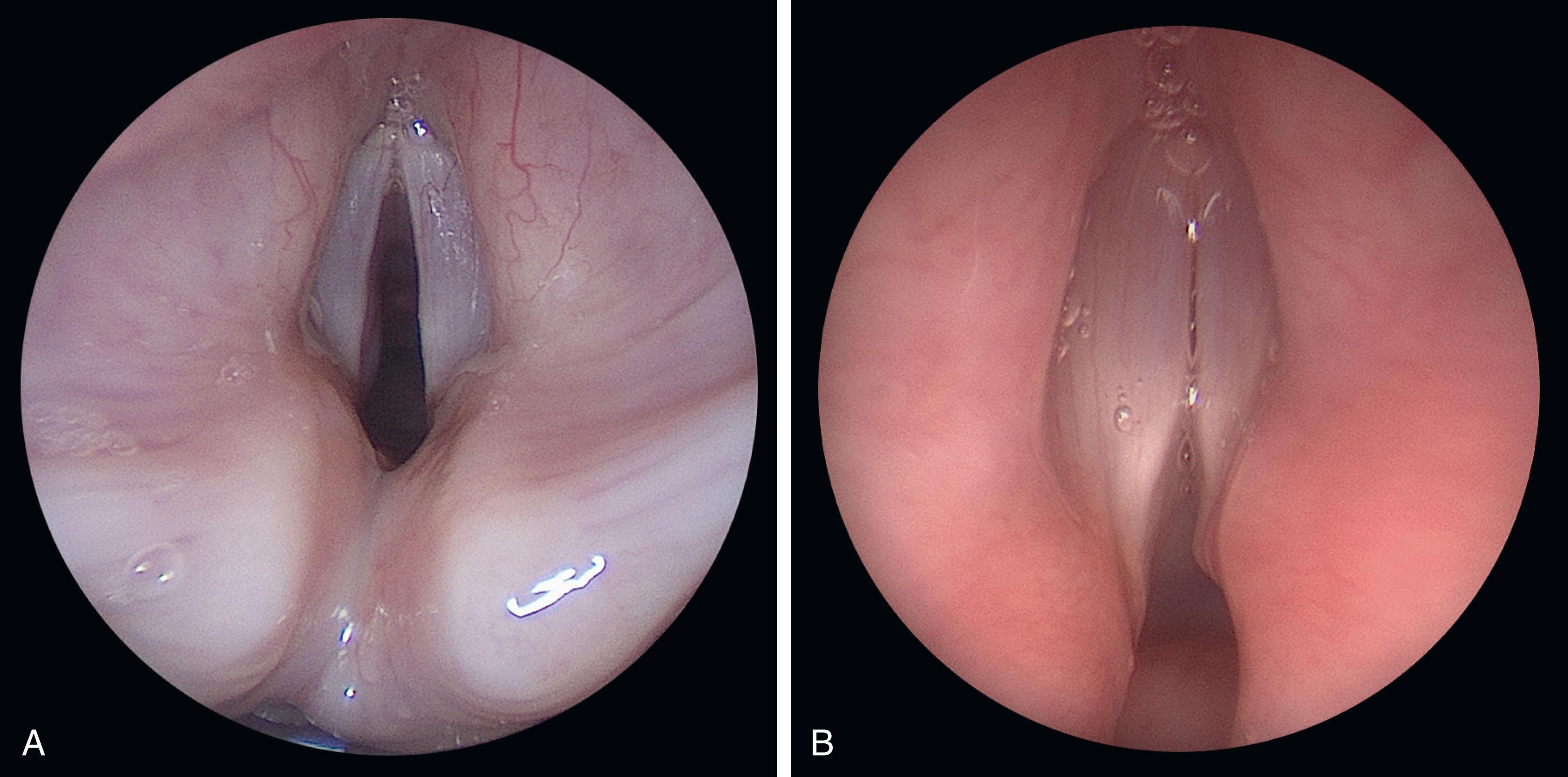 Fig. 44.1, Vocal cord paralysis. (A) Bronchoscopy of a neonate demonstrating a normal glottis. (B) Bronchoscopy of an infant with bilateral true vocal cord paralysis causing obstruction.
