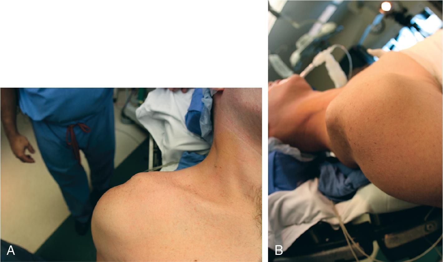 Fig. 38.1, High-Grade (Type V) Acromioclavicular Separation.