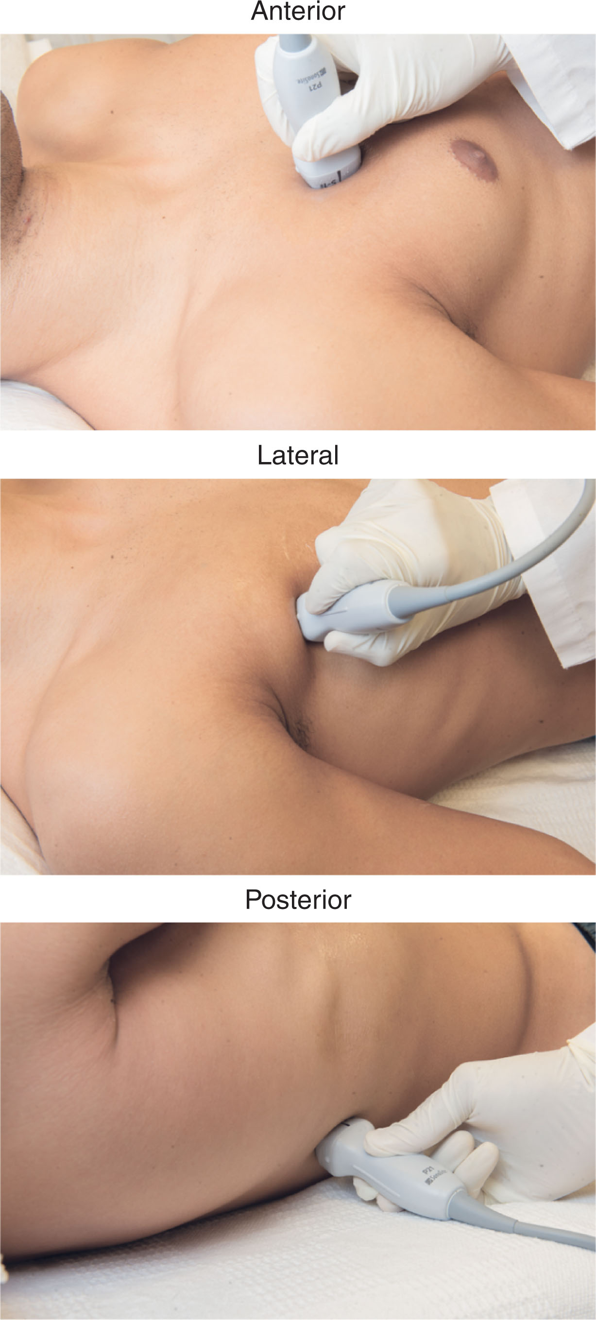 Fig. 30.3, The probes utilized to evaluate the lungs include the curvilinear (for good penetration with low frequency), the linear (for pleural surface detail with high frequency, shown here), or the phased array transducer (for visualization of the pleural surface and the pleural fluid).