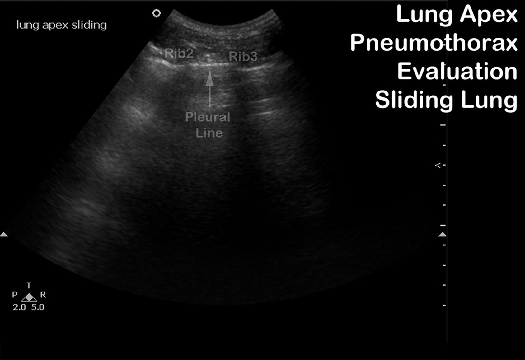 Fig. 30.4, Ultrasound evaluation of the pleural line to look for lung sliding or lung pulse is done by looking for movement at the pleural line.