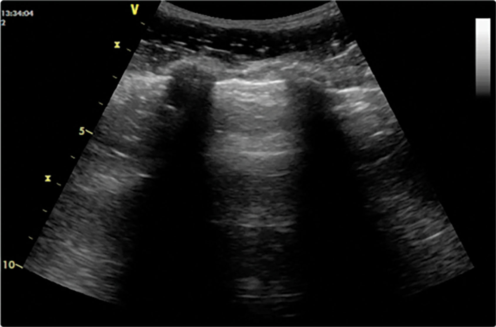 Fig. 30.6, Horizontal artifacts, or B-lines, below the pleural line may be seen when the pleural line is perpendicular to the line of interrogation of the ultrasound beam.