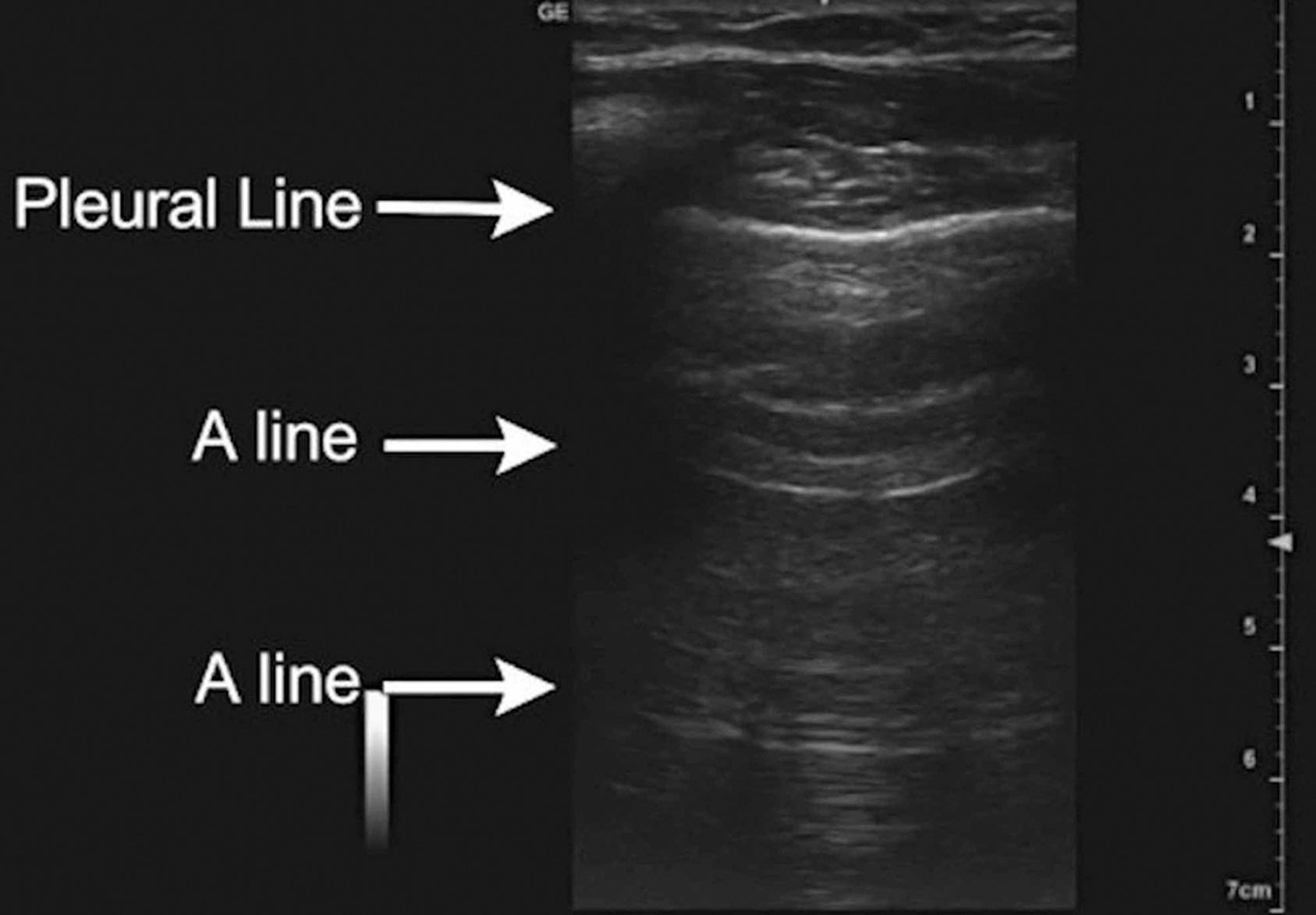 Fig. 30.7, Lung that is normally aerated has a characteristic pattern of air artifact designated as A-lines. These A-lines indicate air, whether physiologic of or pathologic. A-lines are horizontally oriented hyperechoic lines seen deep to the pleural line.