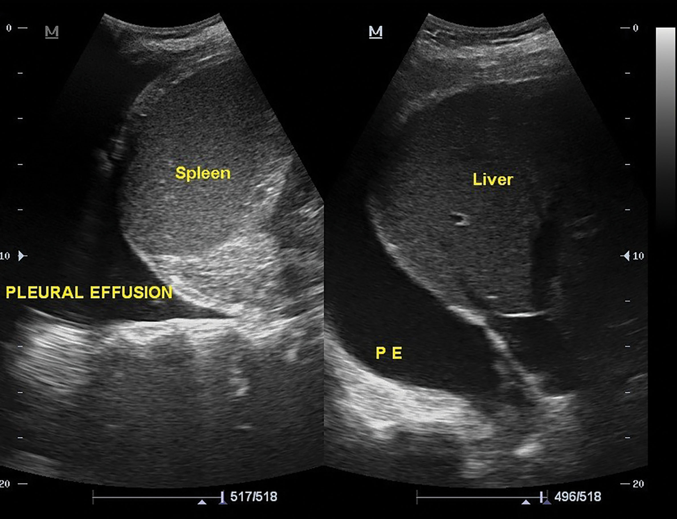 Fig. 30.8, In the presence of a pleural effusion, the costophrenic angle is filled with fluid that allows the ultrasound to reach the spine.