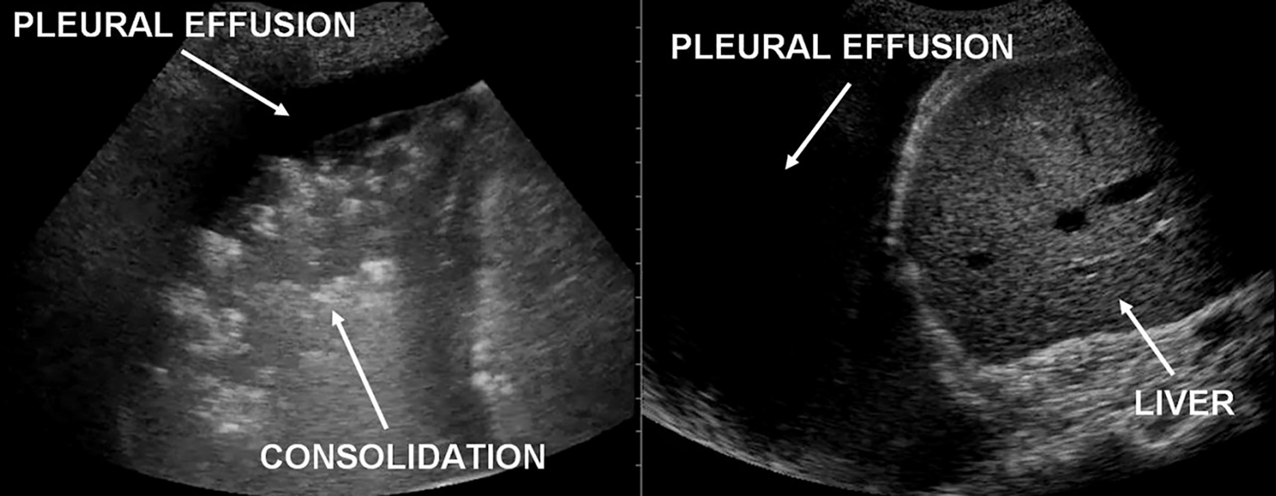 Fig. 30.9, Consolidation/pleural effusion.