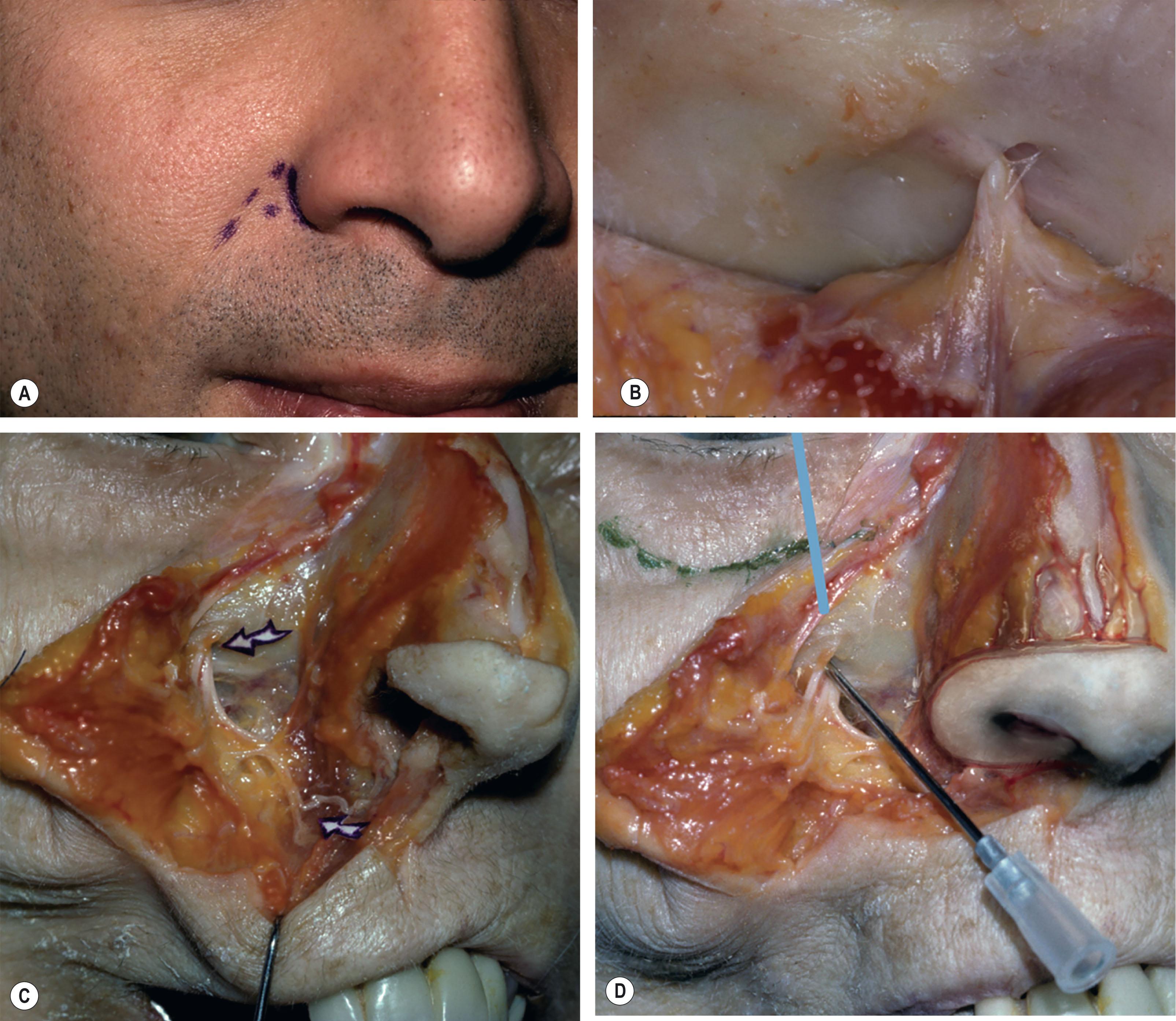 Figure 5.2, The infraorbital nerve block and optimal access. (A) The entry point of the isthmus to best enter the skin. (B) The general direction of the foramen, which has a caudal/medial trajectory from deep to superficial. (C) Infraorbital nerve, which lies in a line drawn down directly below the medial limbus. (D) Needle entering at the isthmus and in close proximity to the foramen.