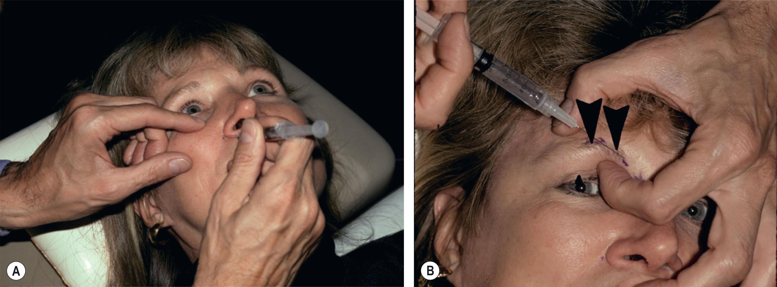 Figure 5.3, The author’s access for both the infraorbital and supraorbital, supratrochlear, and infratrochlear nerve blocks. (A) The ergonomic drip of the syringe, with the needle entering at the isthmus and positioned toward the infraorbital foramen. (B) The author’s finger protecting the globe and entering the medial third of the brow to block the supraorbital, supratrochlear, and infratrochlear nerves.